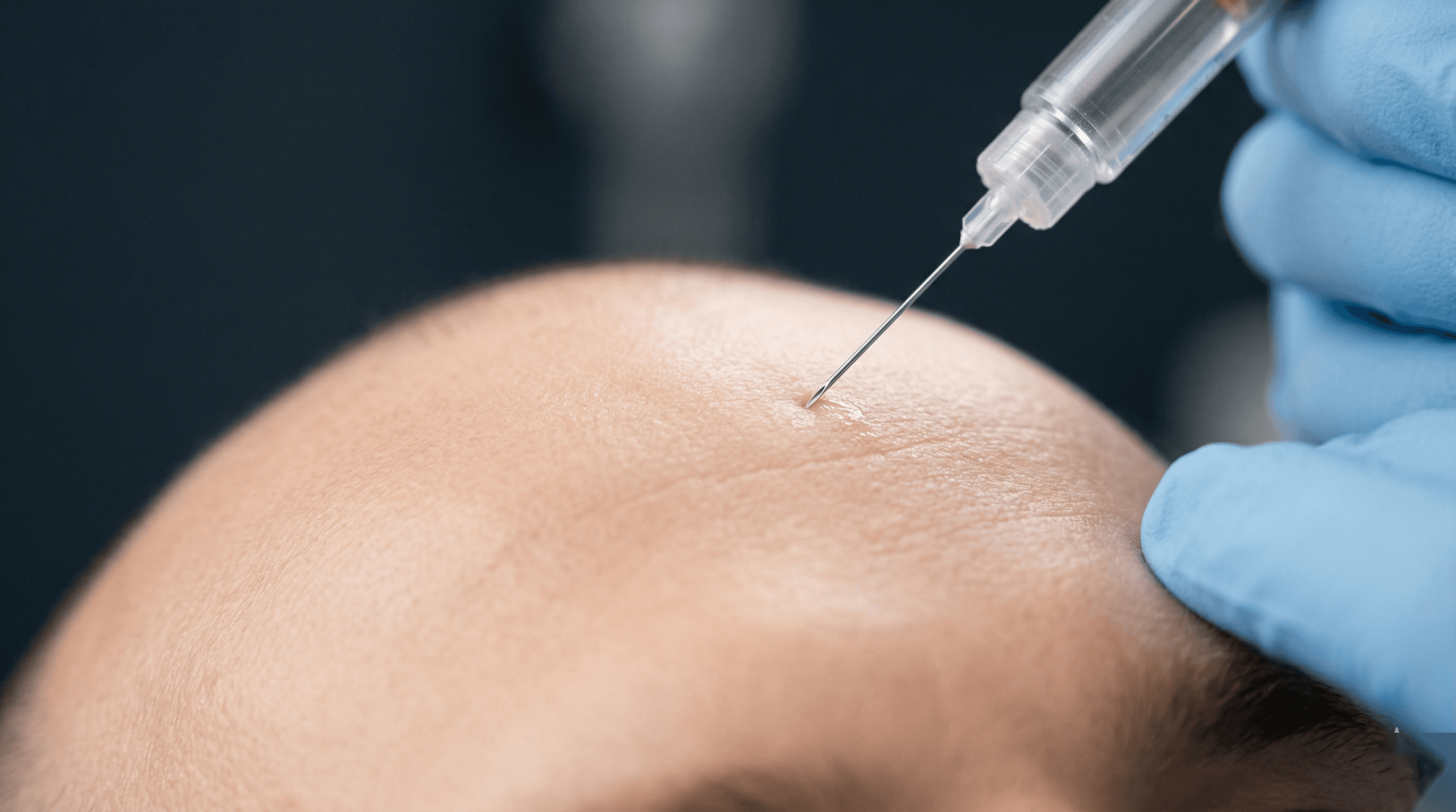 Aplicação da Toxina Botulínica — imagem do procedimento